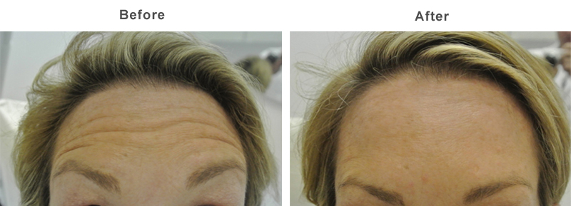 Anti-wrinkleTreatment
